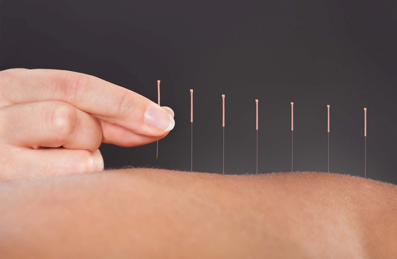 4 Places to Get Acupuncture in Shenzhen