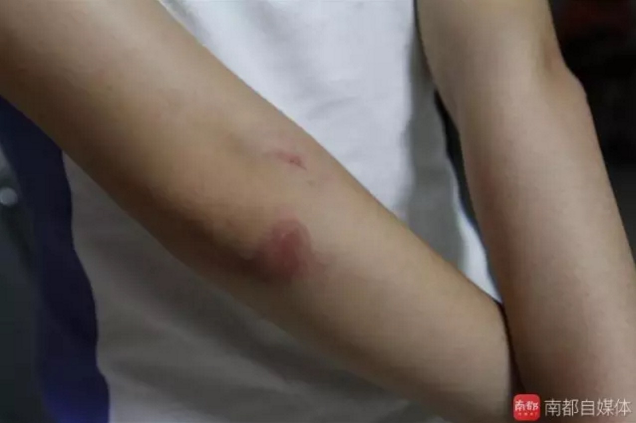 xiaoyu arm bruise