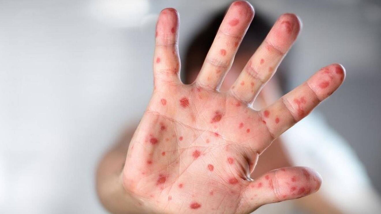 New research claims Monkeypox virus can exist in one place for months