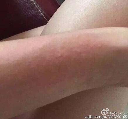 A volunteer posted photos of irritated skin after rain in Tianjin